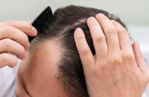 أفضل عمر لزراعة الشعر للرجال