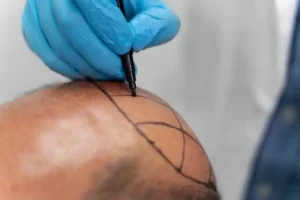 أهم الأسئلة قبل إجراء زراعة الشعر