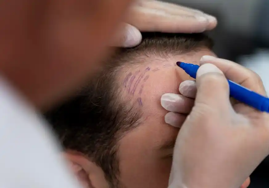 الفرق بين زراعة الشعر DHI وFUE