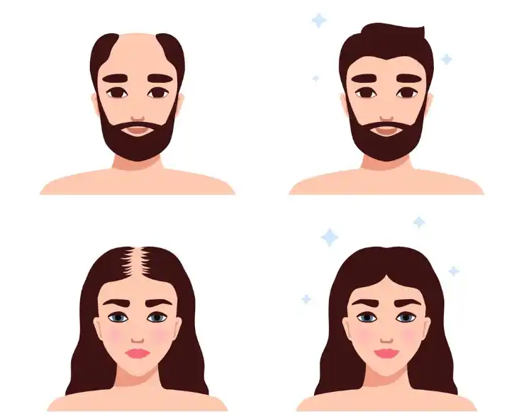 الفرق بين زراعة الشعر للنساء والرجال