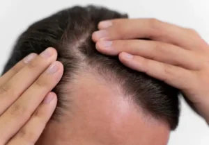 تقنية FUE Sapphire في زراعة الشعر