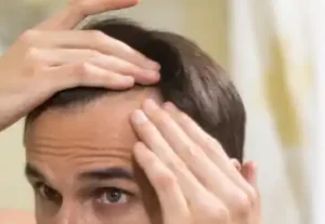 مراحل نمو الشعر بعد الزراعة