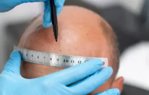 مزايا زراعة الشعر بتقنية القلم Choi Pen