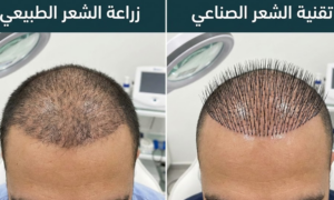 الفرق بين زراعة الشعر الطبيعي والمزروع بتقنية الشعر الصناعي