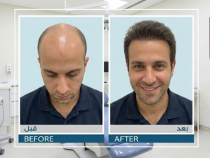 كيف تبدو نتائج زراعة الشعر للرجال قبل وبعد؟
